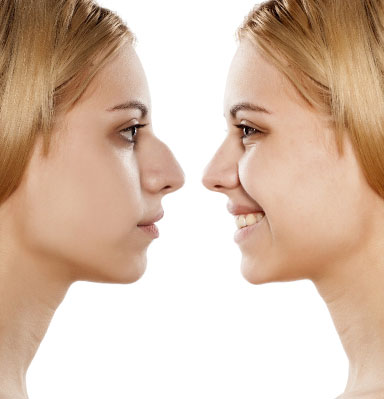 Rhinoplastie